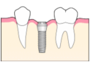 インプラントを埋め込みます
