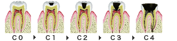 むし歯の進行