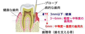 歯周病の検査方法と進行度
